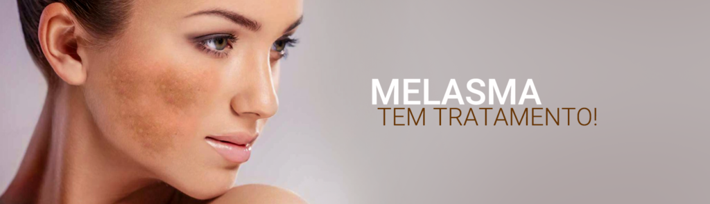 tratamento-melasma-barra-tijuca